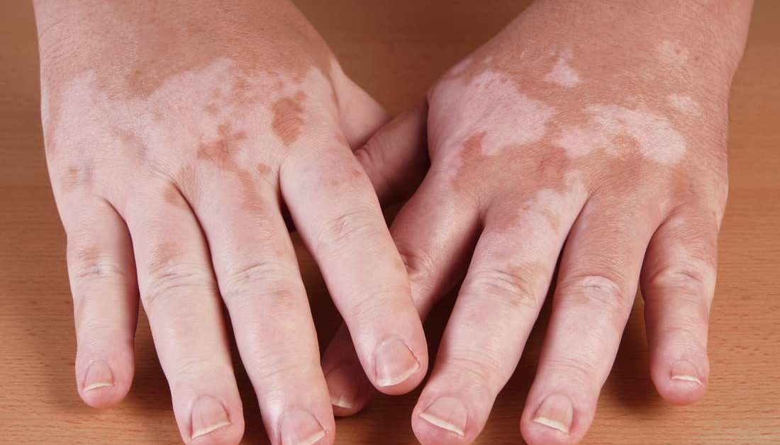 Wyniki tego przeglądu systematycznego i metaanalizy sugerują, że fototerapia UV jest bezpieczną metodą leczenia bielactwa bez znaczącego ryzyka raka skóry.